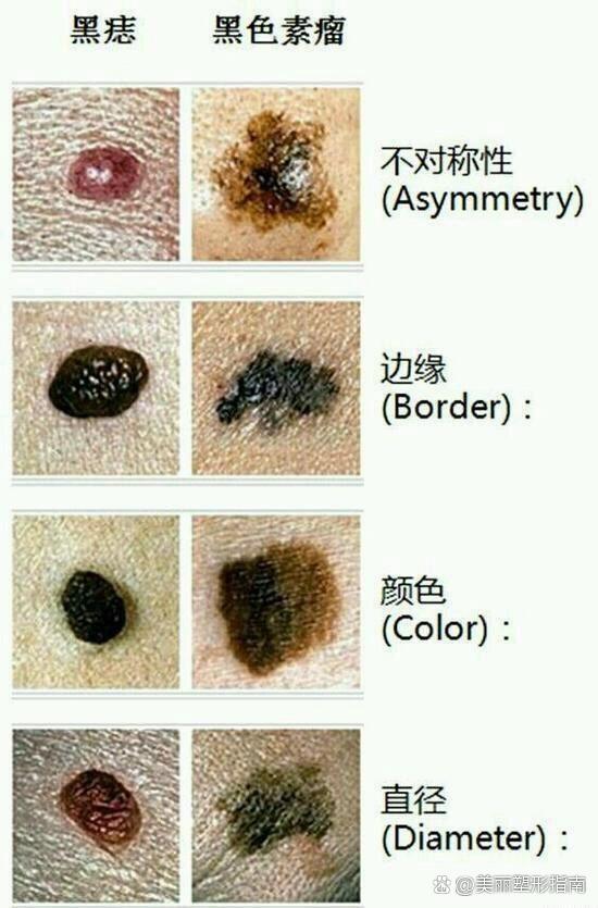 各种痦子肉猴安全祛除