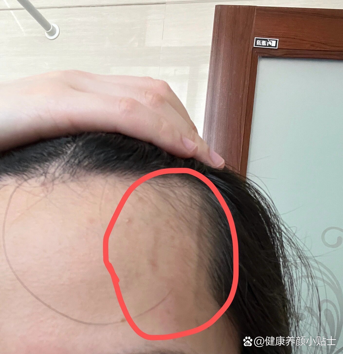昨天熬夜后发现太阳穴青筋暴起是什么原因