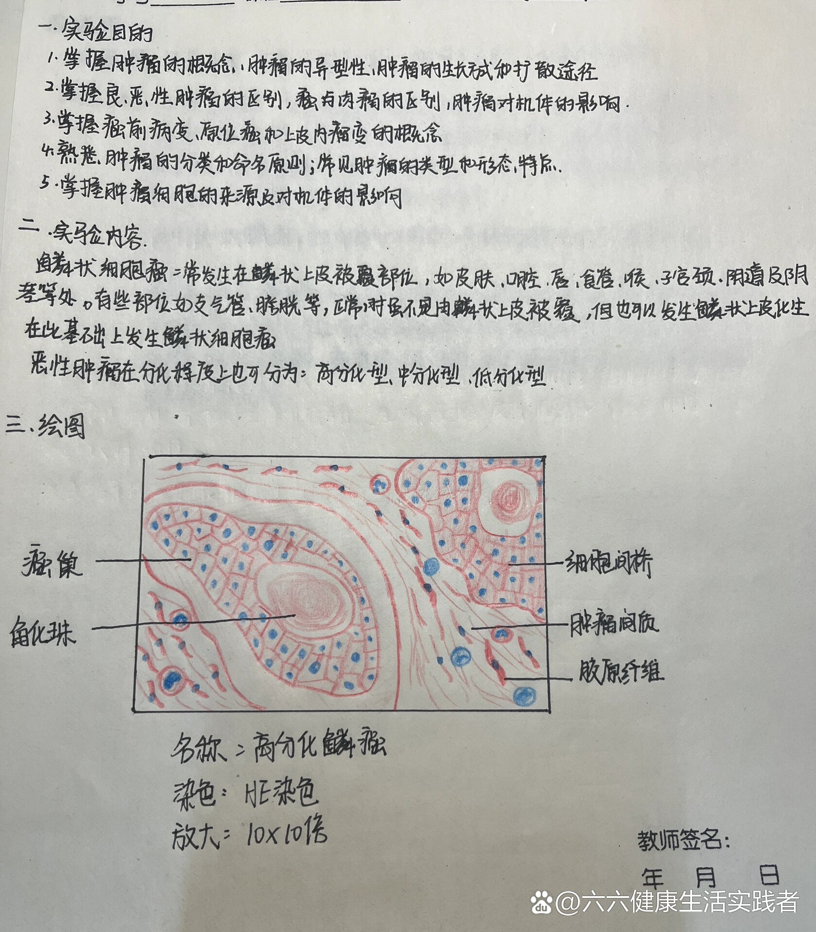 高分化鳞癌(病理学实验报告)