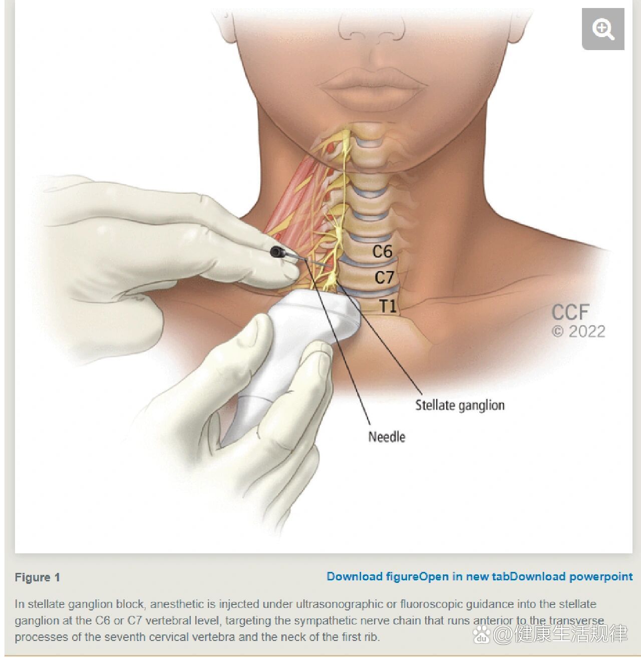 星状神经节阻滞治疗失眠