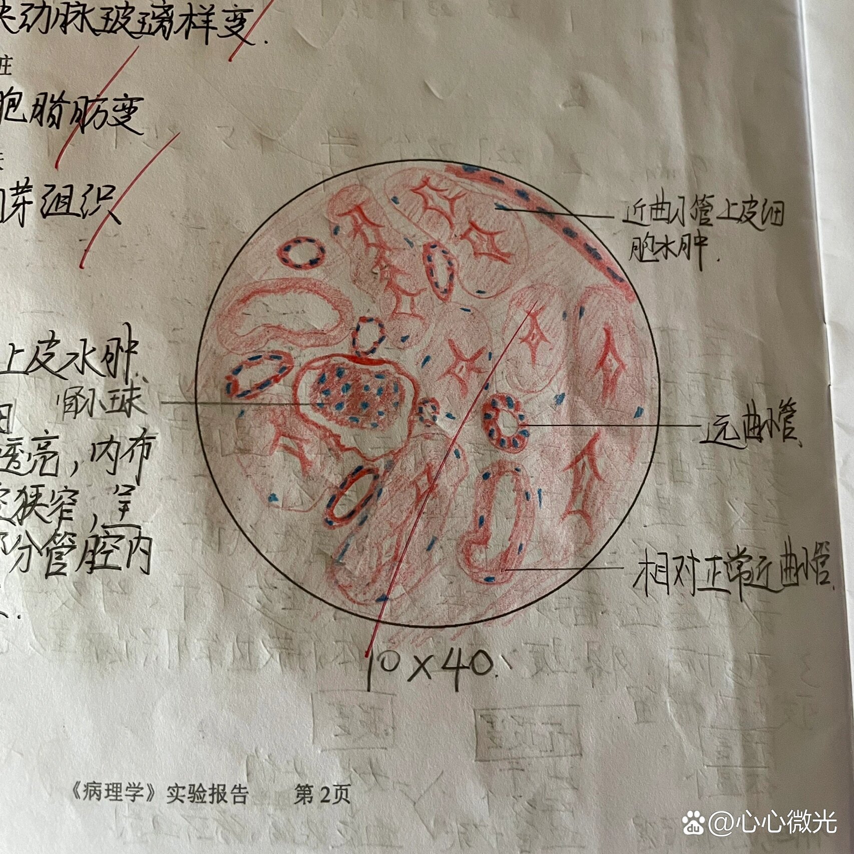 慢性肾炎红蓝铅笔绘图图片