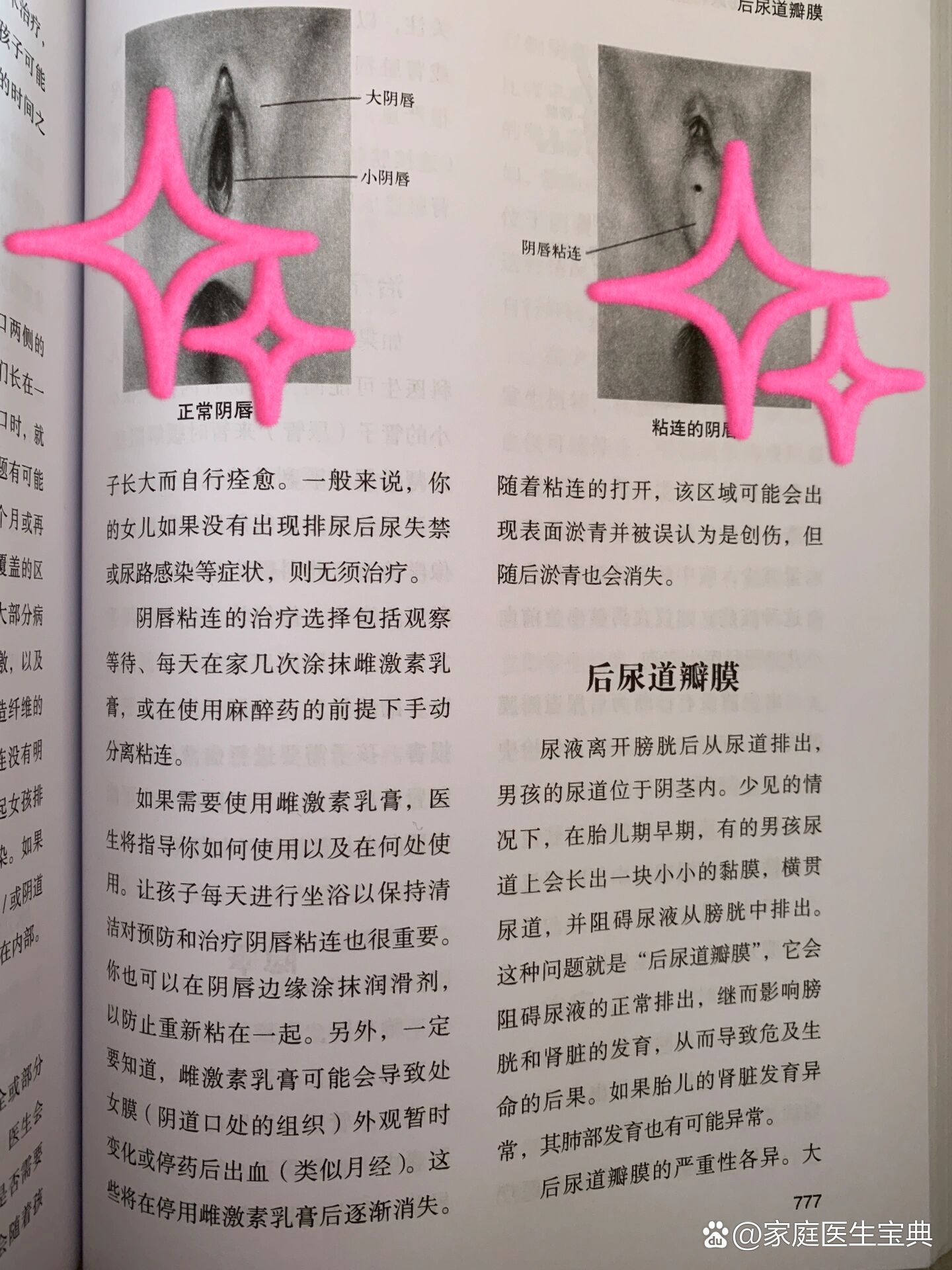 女婴yin唇粘连可自愈不用处理(附图)