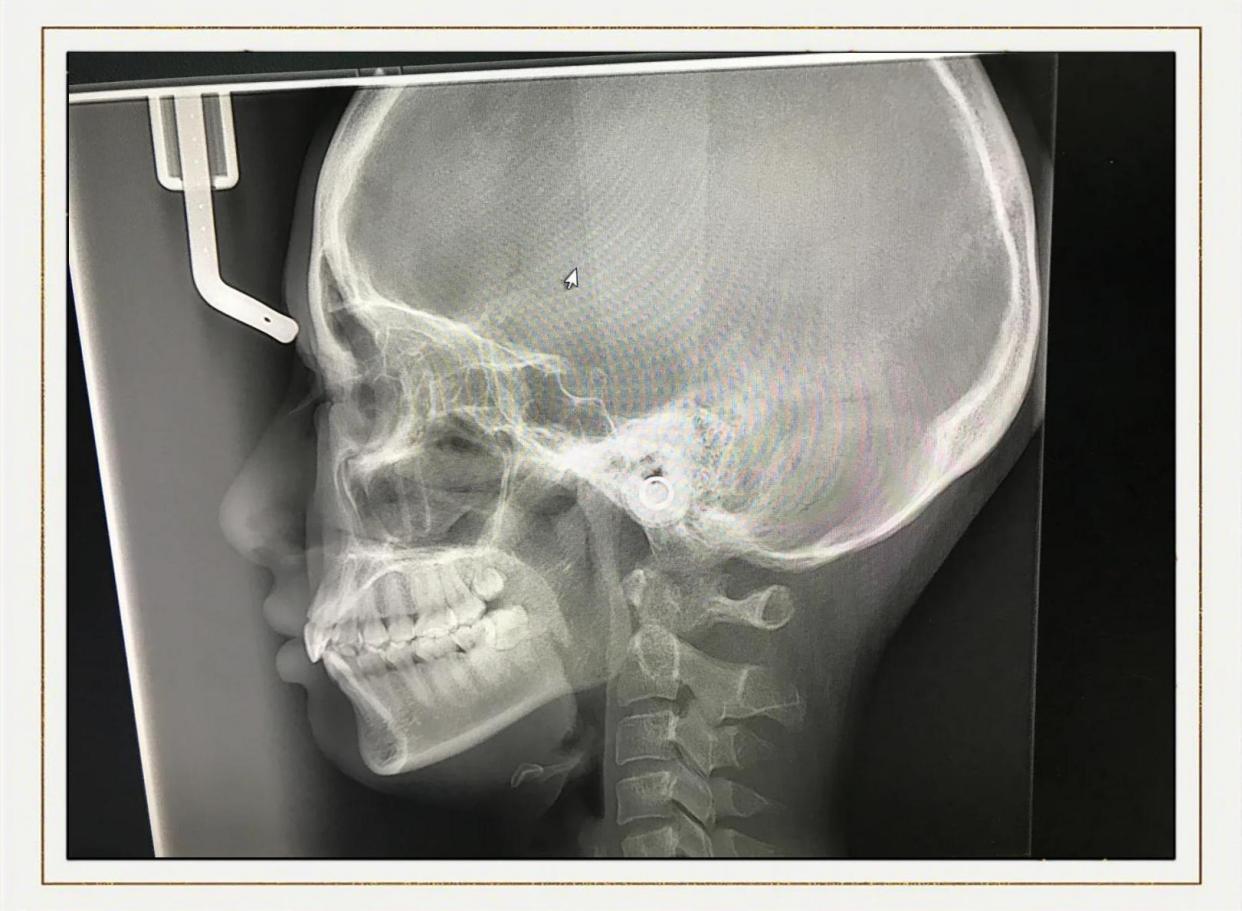 杭州骨性嘴凸正畸面诊体验分享
