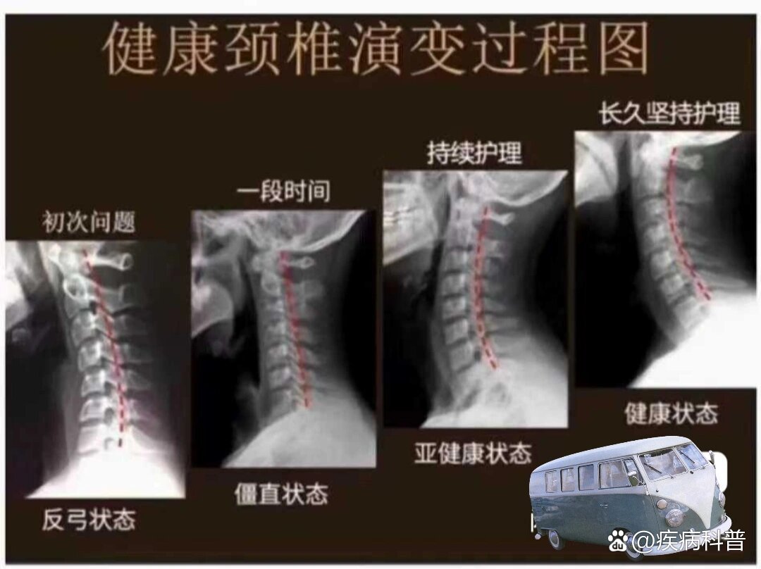 正常颈椎和生理曲度变直对比