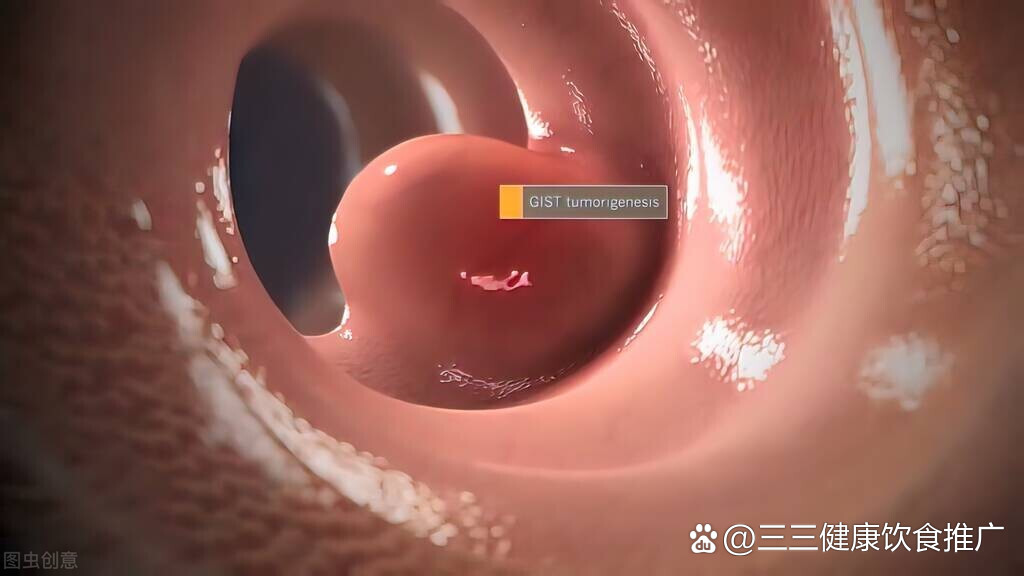 其中一些人总把自己这个病误称为胃癌,其实胃间质瘤并不一定都是恶性