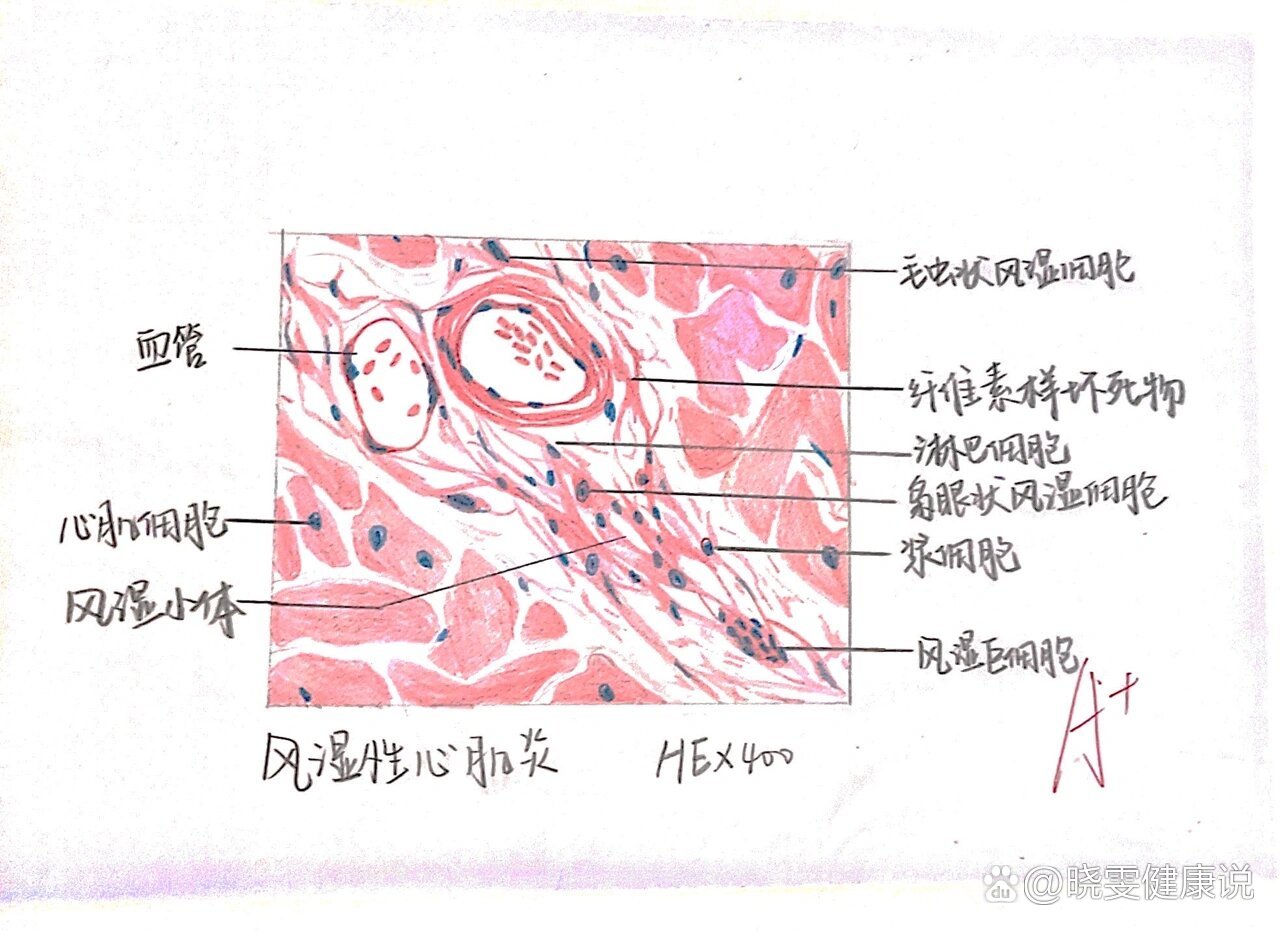 乙脑病理红蓝铅笔图图片