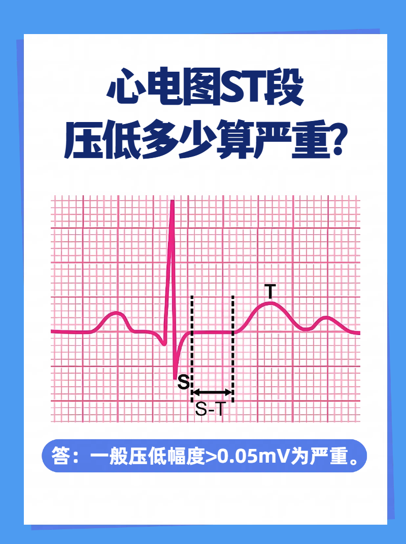 心电图电压图片