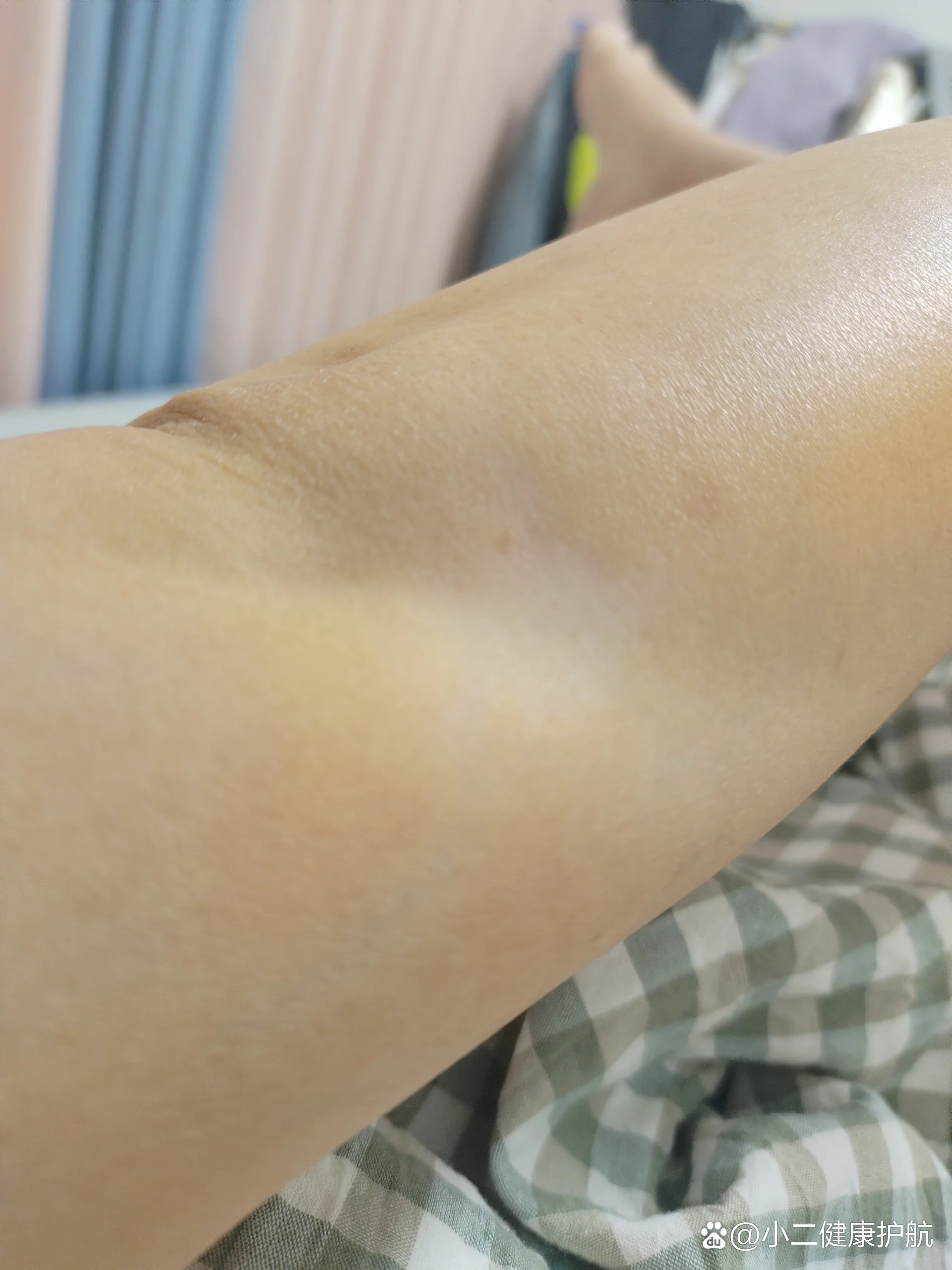 1月17号因为网球肘,去看医生,在不知情的情况下给我打了封闭,2个月