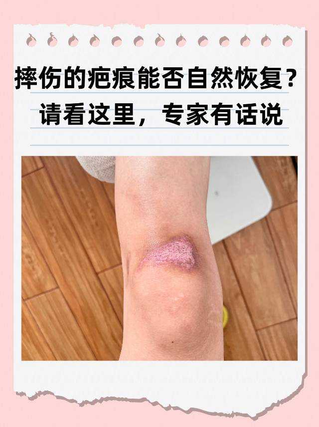 摔伤的疤痕能否自然恢复?请看这里,专家有话说