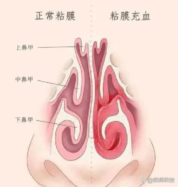 健康的鼻黏膜,不管白天,夜晚,都不会鼻塞
