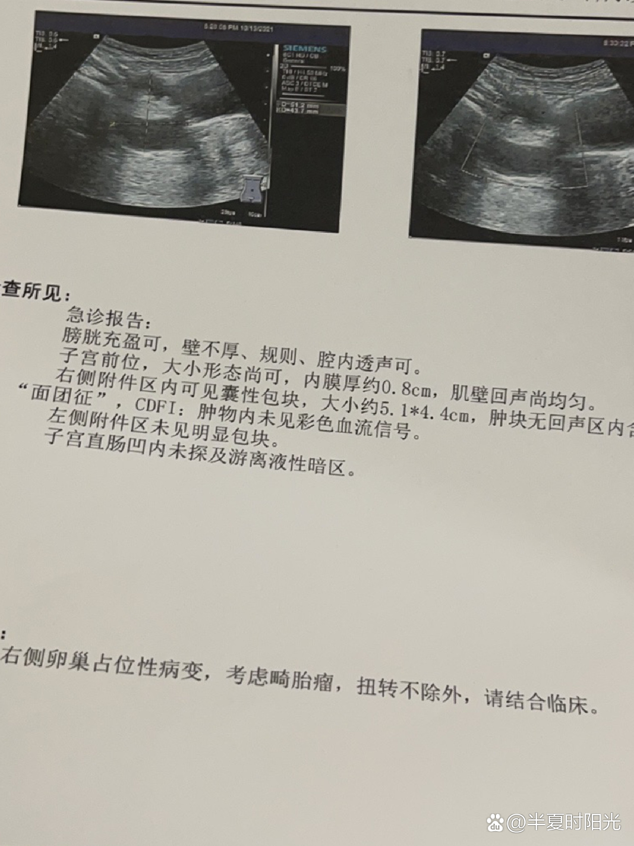 畸胎瘤手术其实也没有那么可怕!