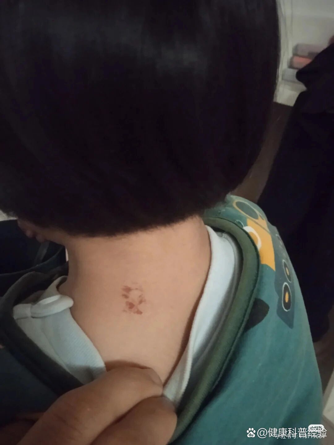 第二次血管瘤激光,对比