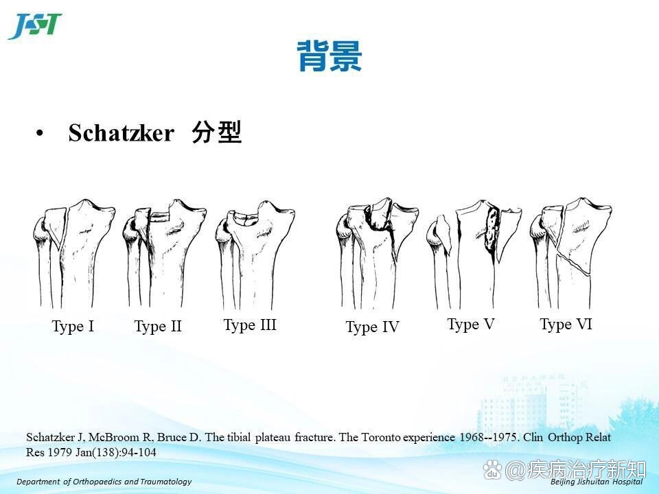 胫骨平台粉碎性骨折分型