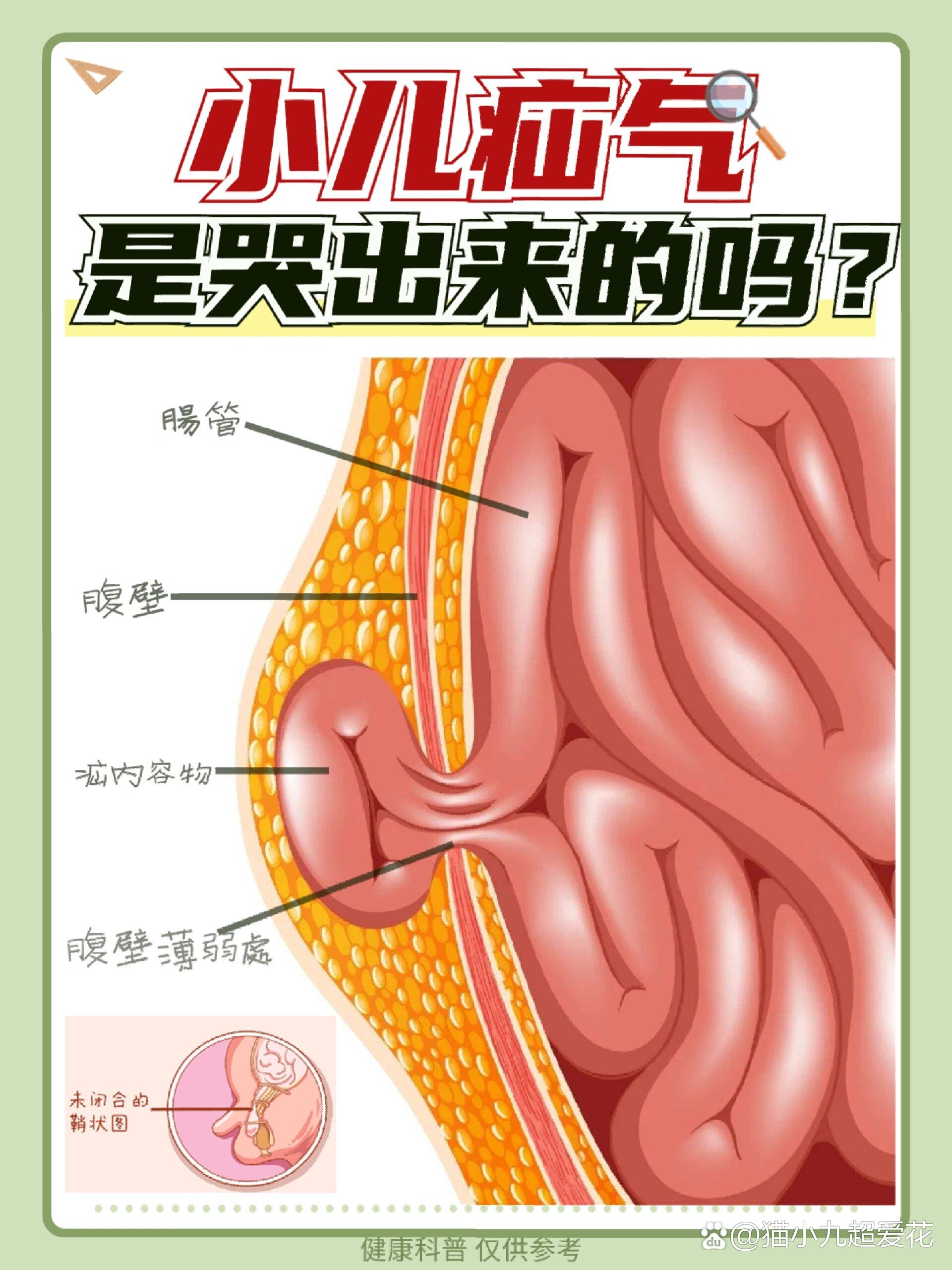 小肠气掉到睾丸图片图片