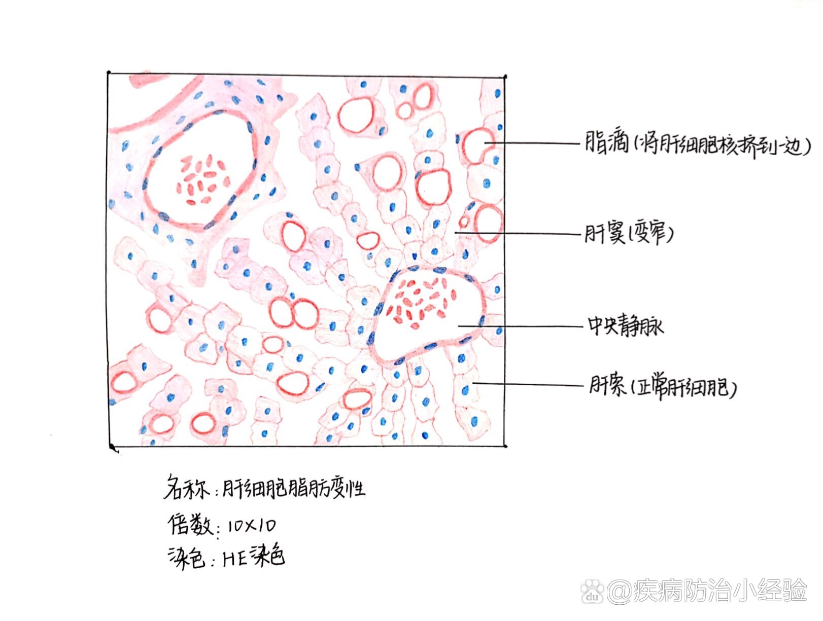 肝细胞癌红蓝铅笔图图片