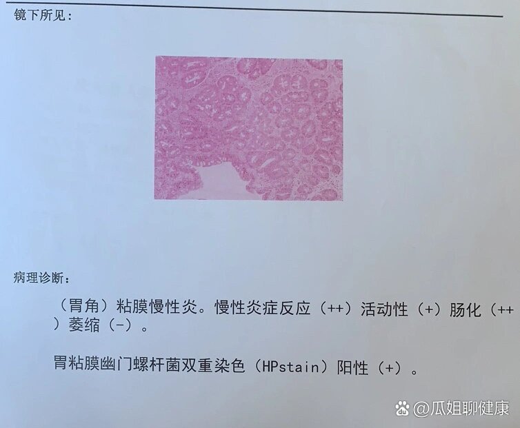 慢性萎缩性胃炎c3伴肠化