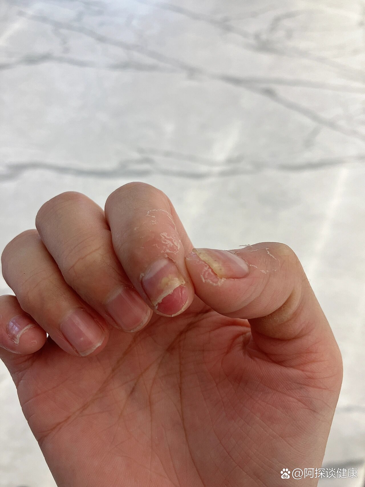 连续性肢端皮炎到底怎么治啊?