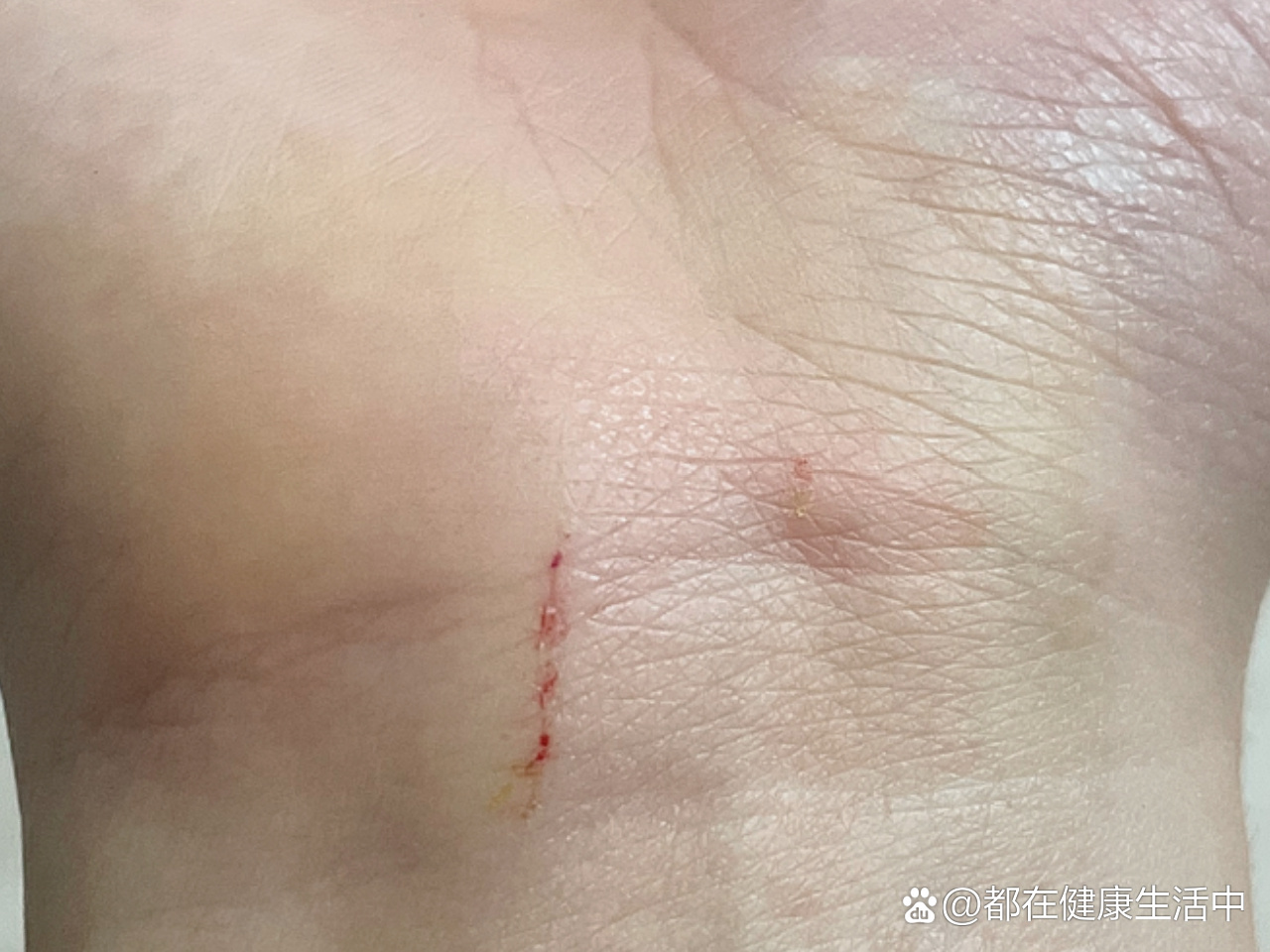  p>破伤风 br>这种伤口需要打破伤风吗 br> br>	 br>我发小红书,是