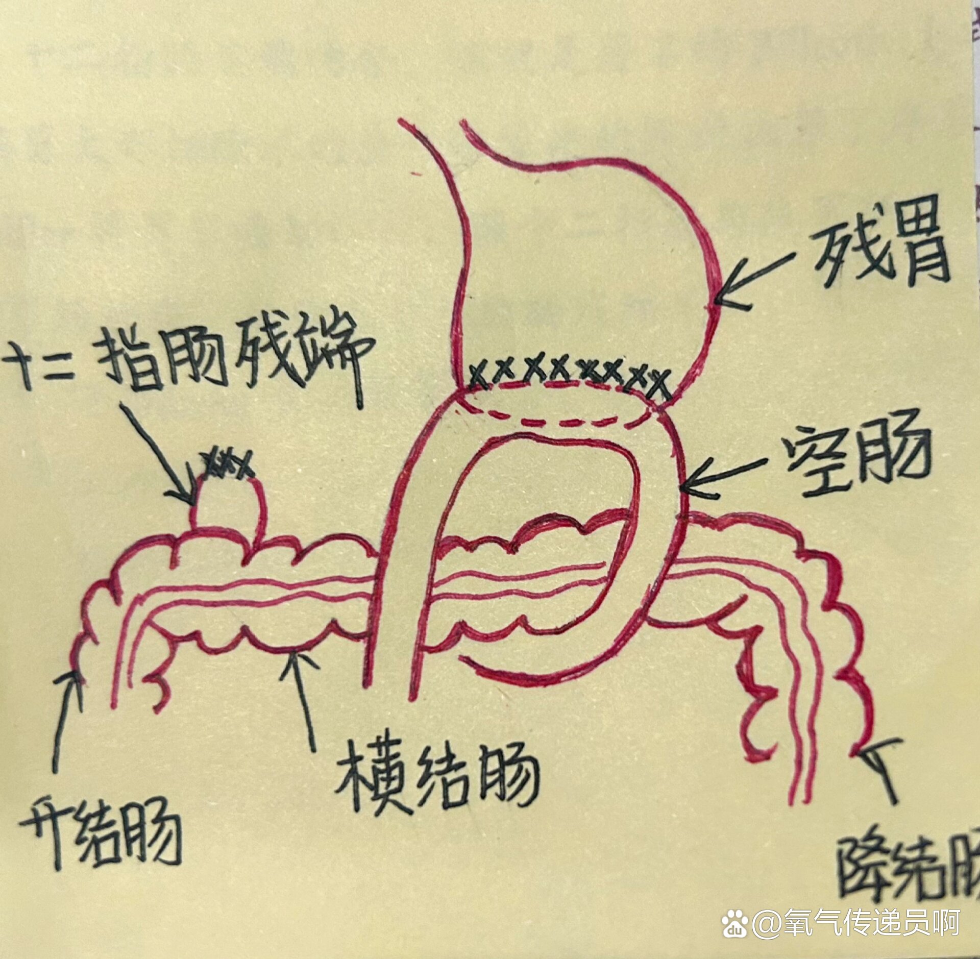 毕二式胃大部切除术图图片