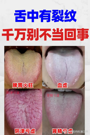 舌头上有裂纹,或是多种疾病征兆!