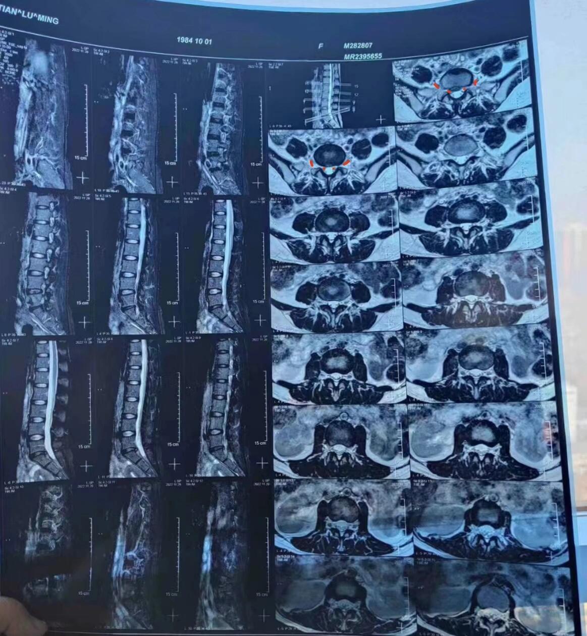 此位mri腰椎影像
