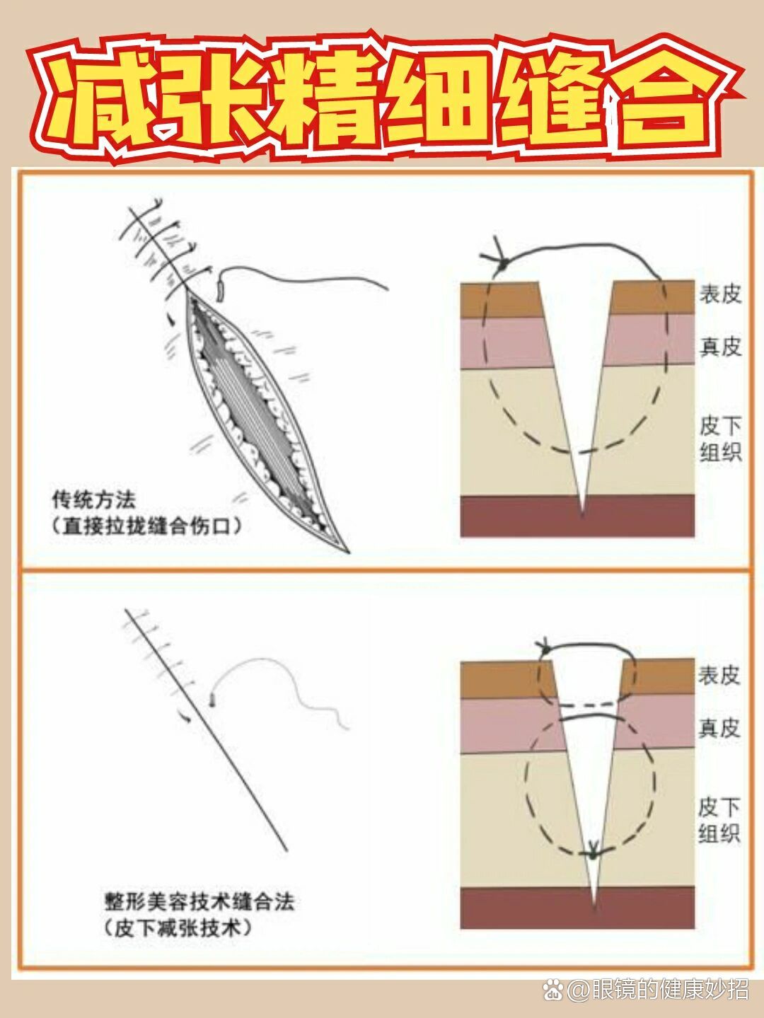 牙龈减张缝合图片