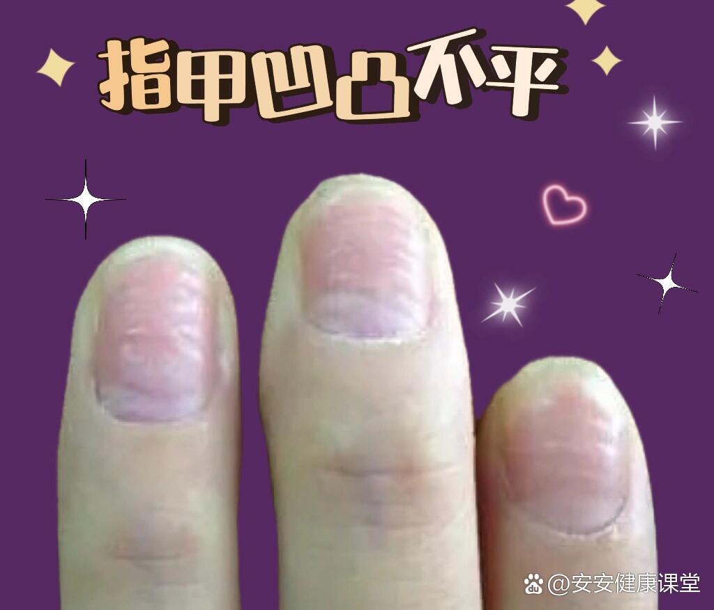 为什么手指甲凹凸不平
