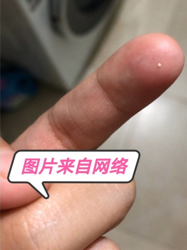 哺乳期堵奶,白点,白泡,颗粒堵奶