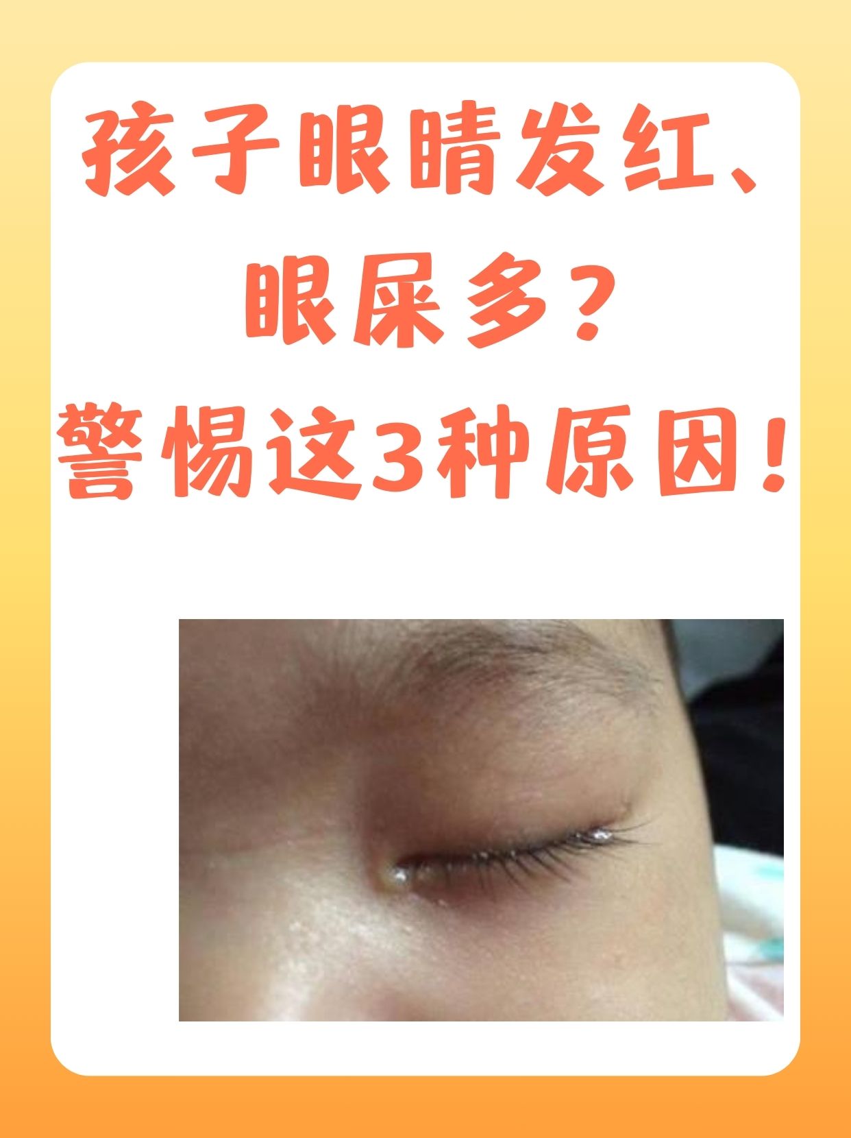 为什么早上起来眼屎多