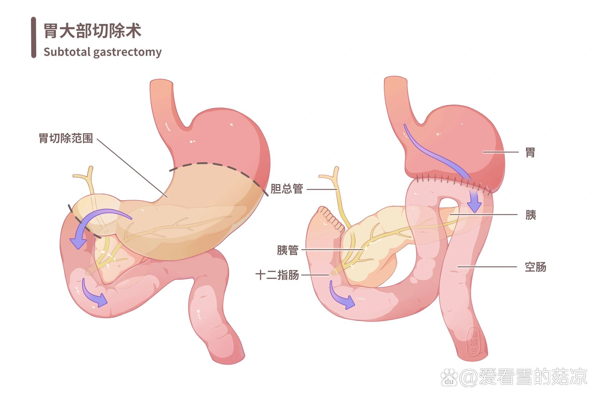 胃大部分切除手术图片