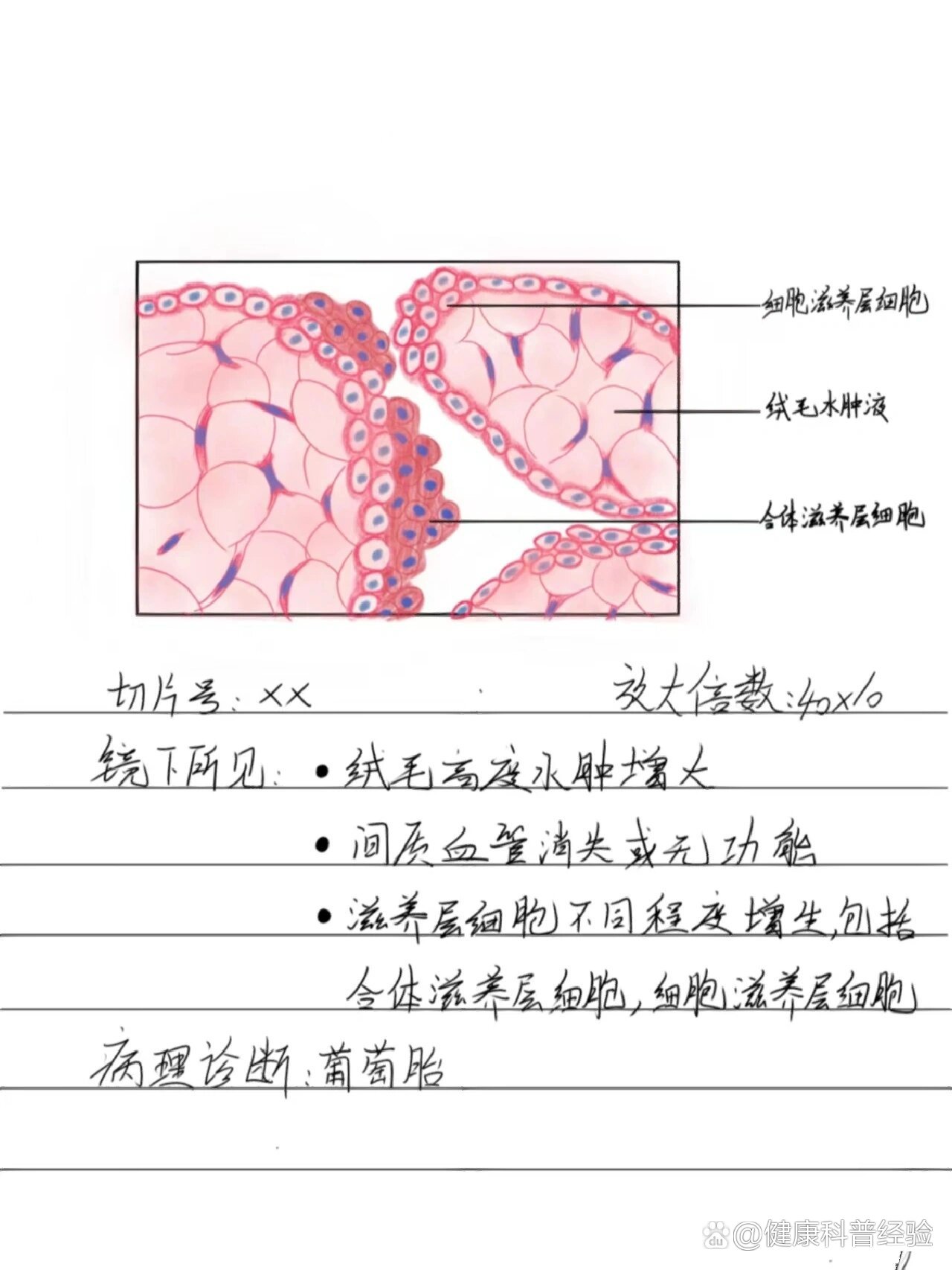 葡萄胎切片绘图图片