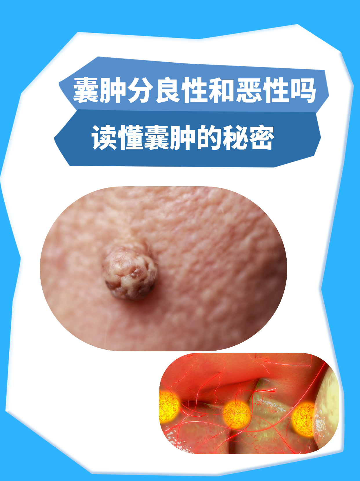 囊肿分良性和恶性吗?一文读懂囊肿的秘密