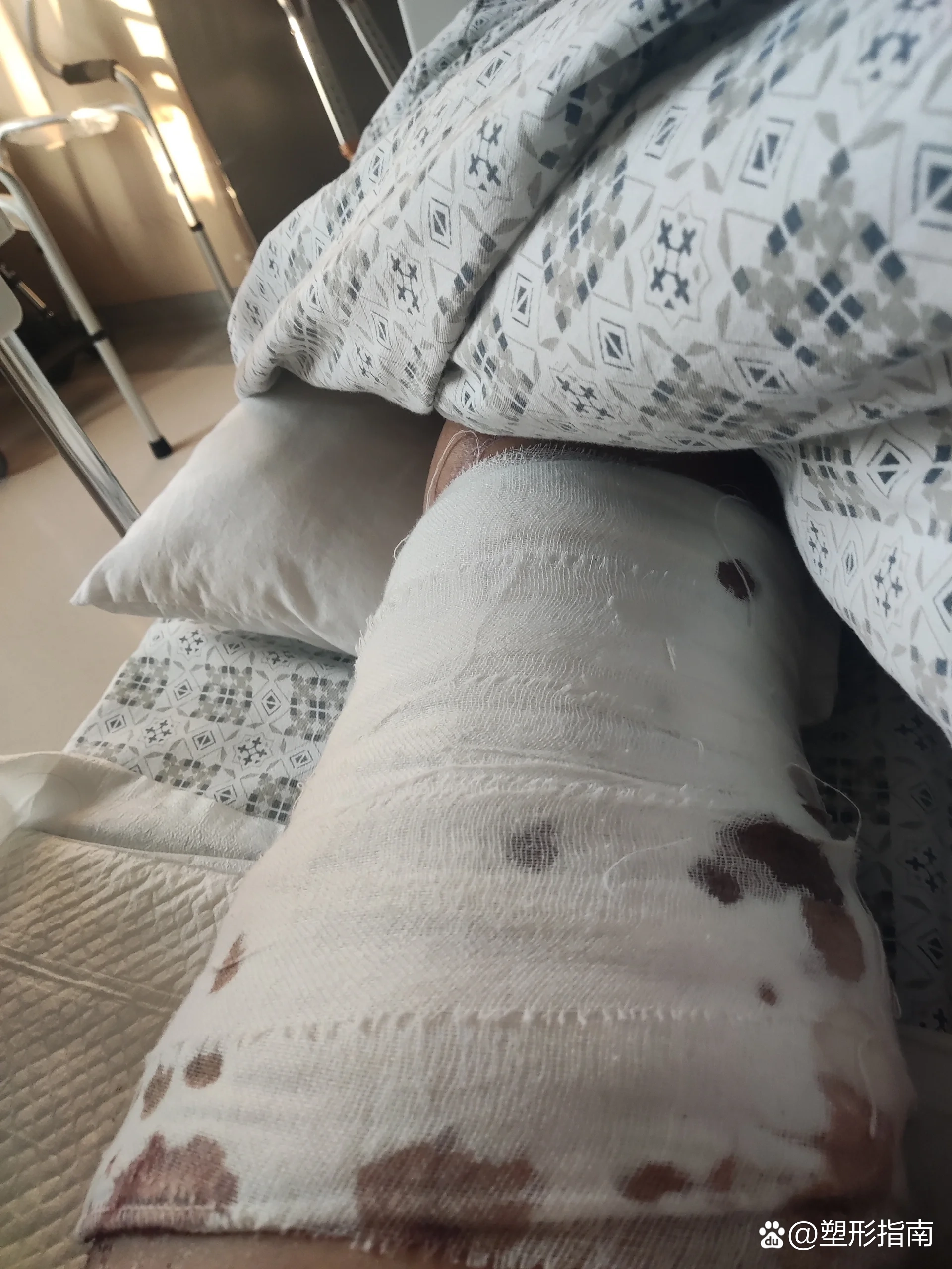 植皮术后79天,我该怎么办