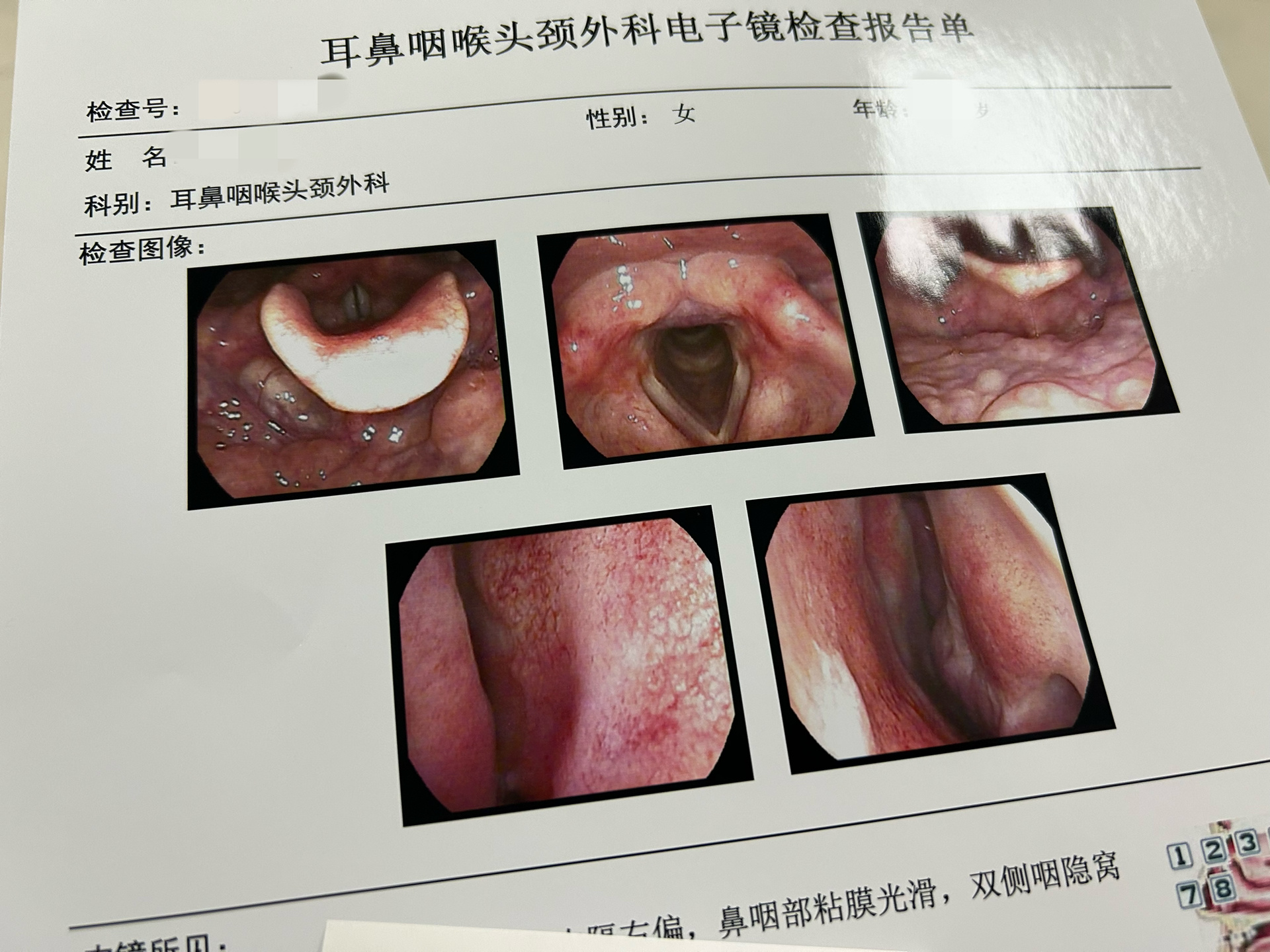 说让做喉镜  br 我一直侵入性检查表示排斥  br 阳康后