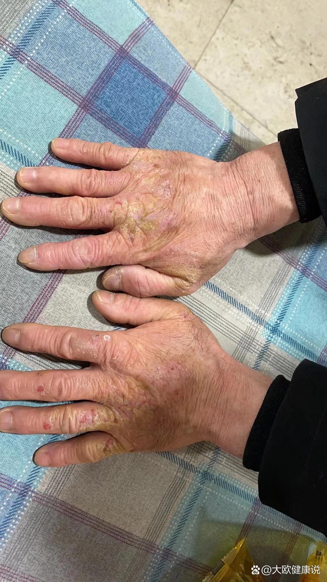 家人确诊手部湿疹好多年了,特别难受尤其是不能碰水,洗碟精等,近期在