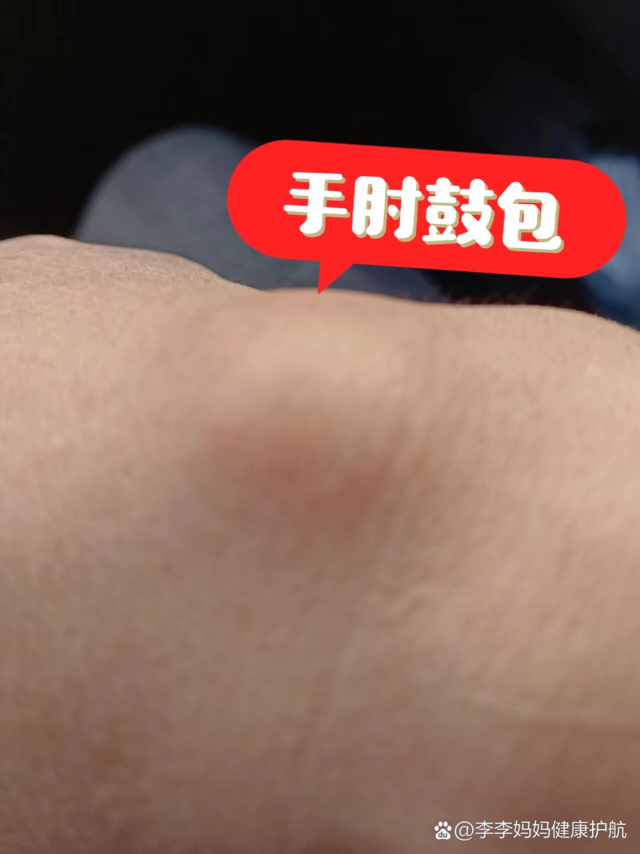 老爸手掌肘长个鼓包