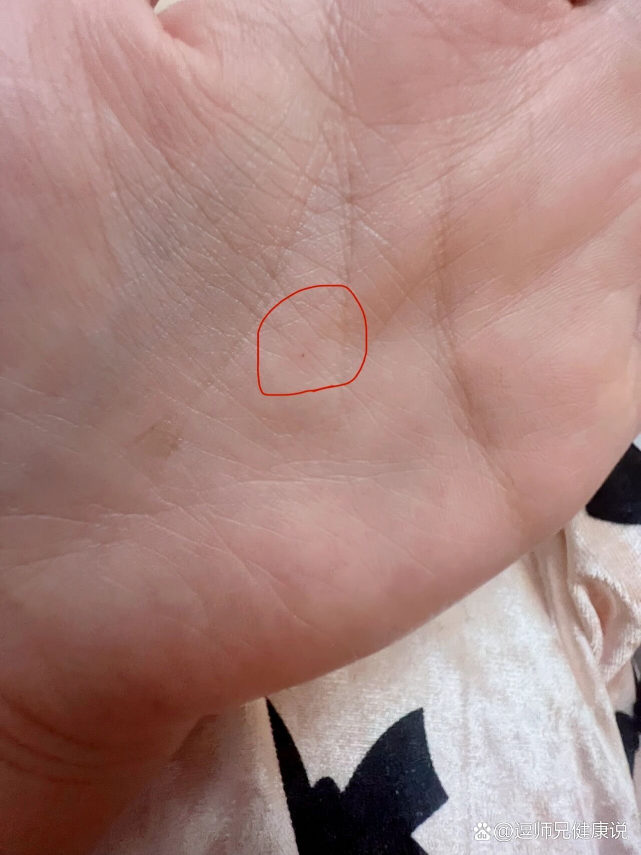 手心一个小红点