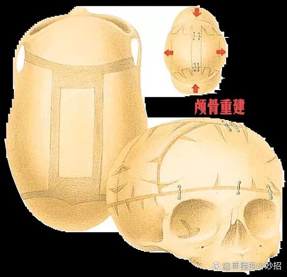 舟状头~矢状缝早闭科普
