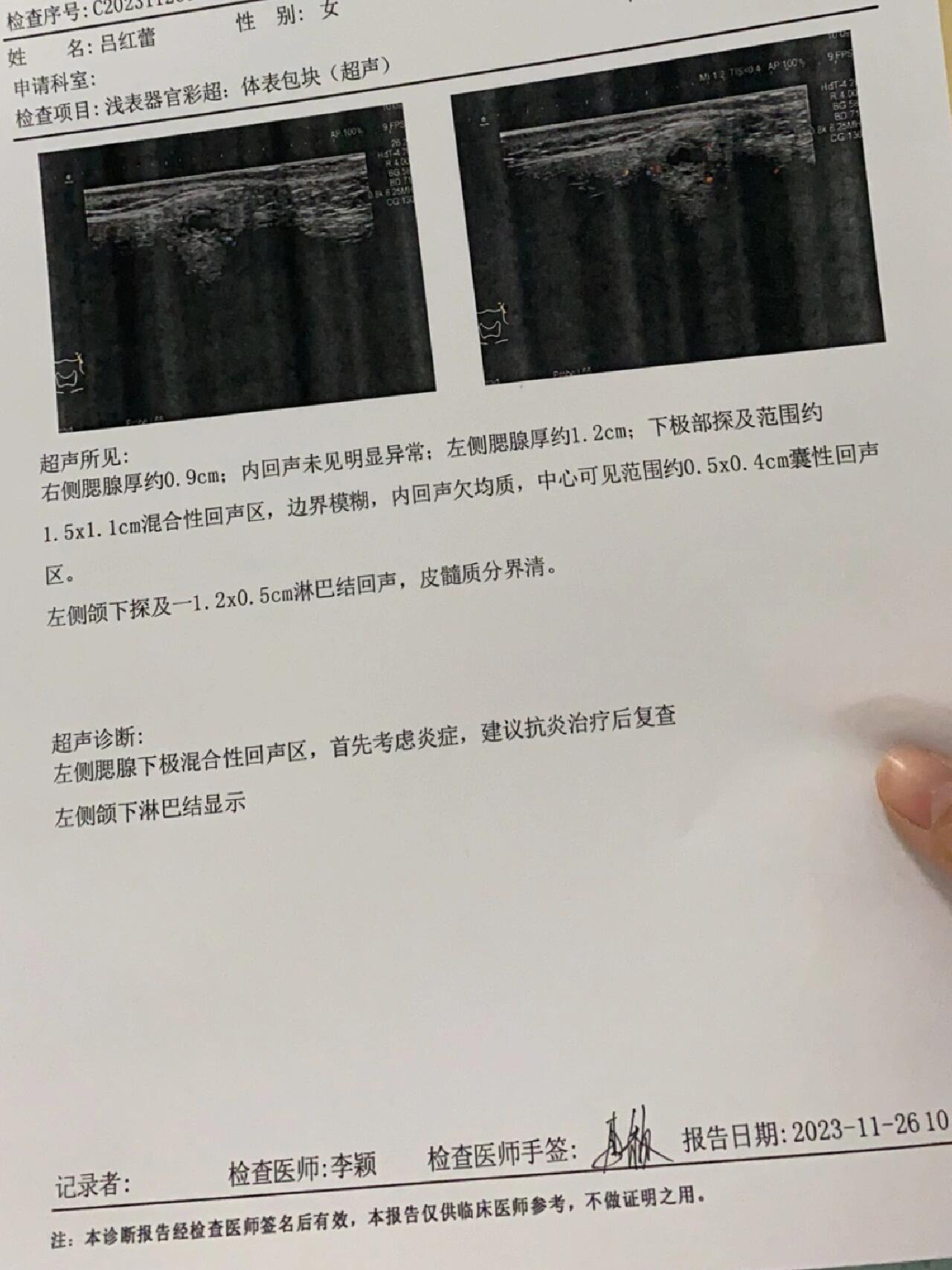 腮腺混合瘤超声表现图图片