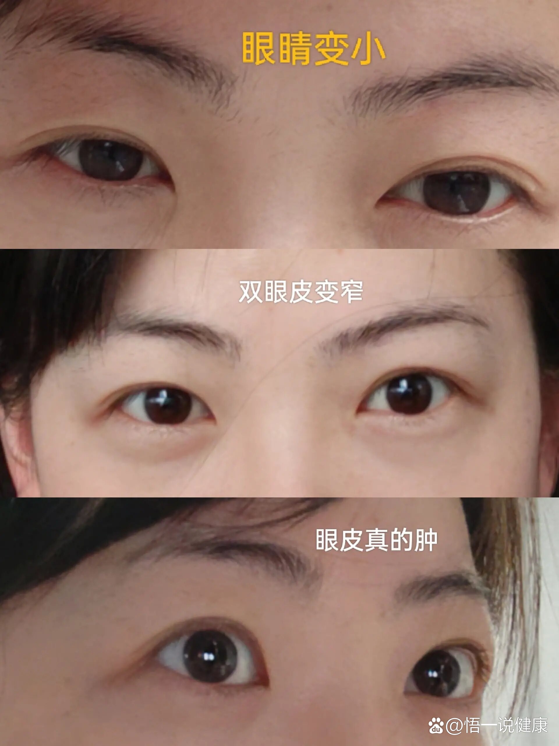 眼眶减压(突眼矫正)成功上岸第18天