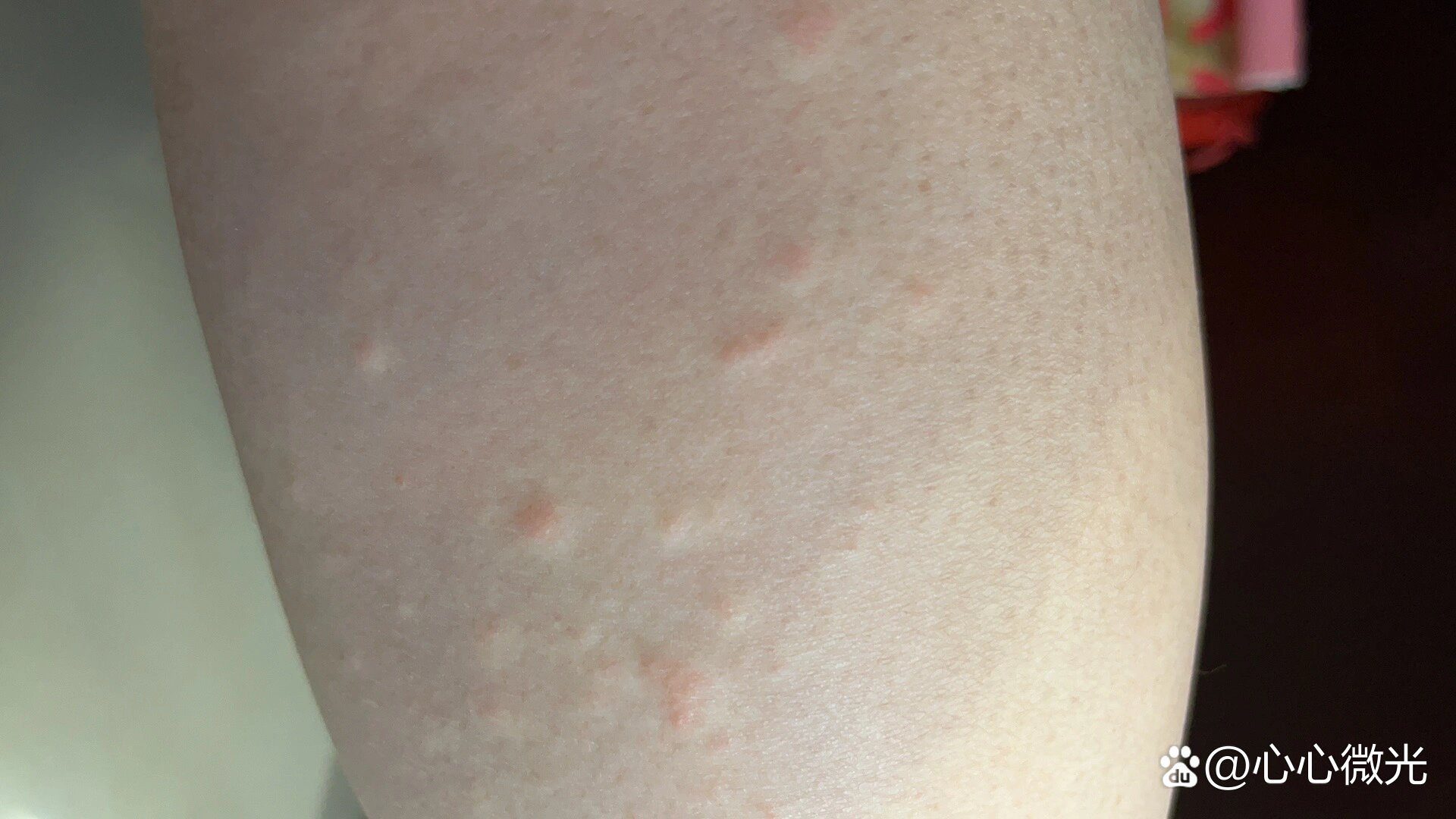 腿上疙瘩,很痒