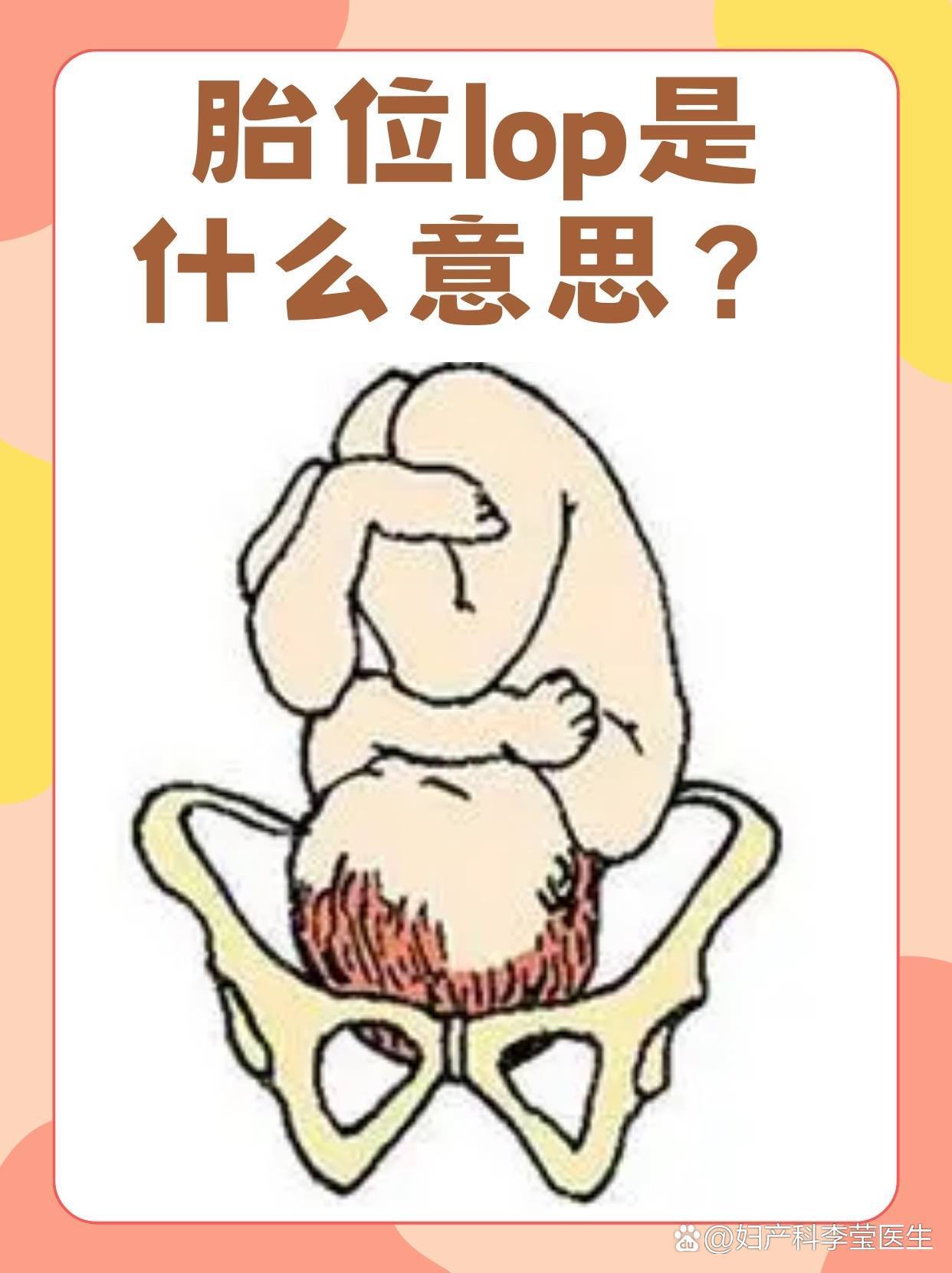 胎位lop是什么意思