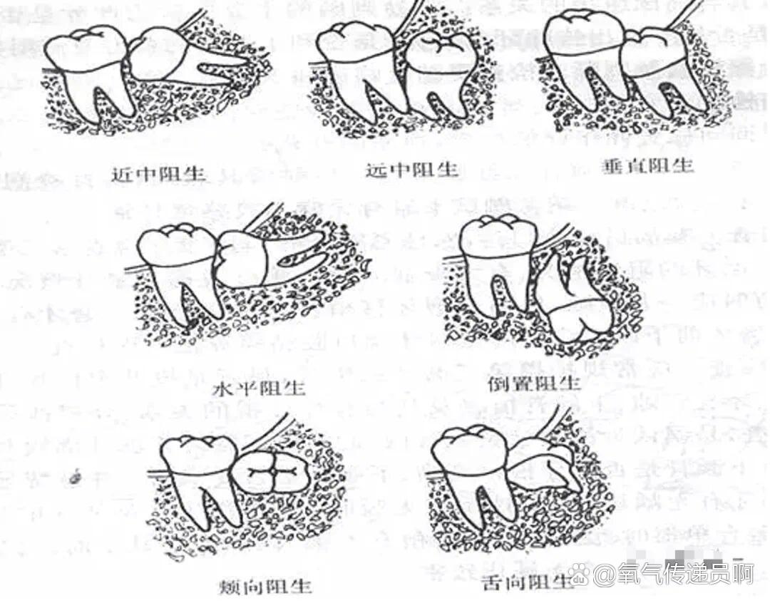 智齿分类图片