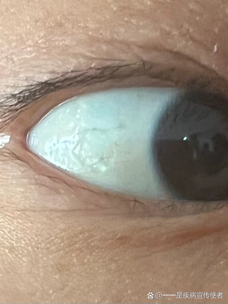 肉眼可见的 眼角膜起褶皱了异物感严重 怎