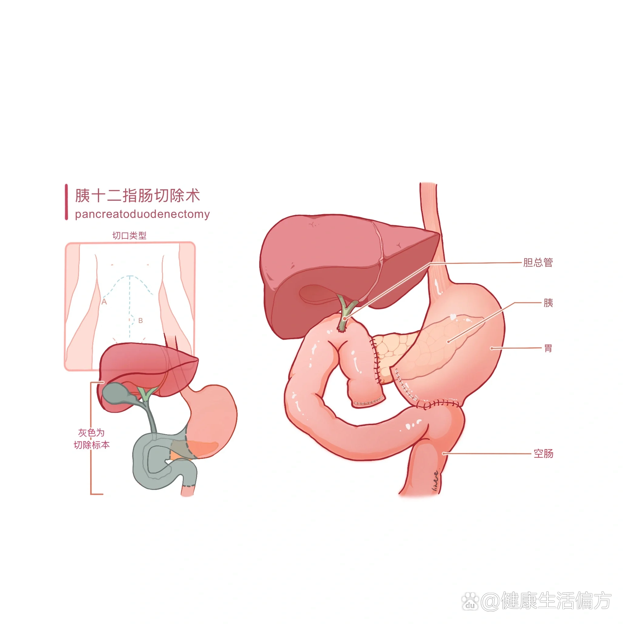 数个大夜,坐等whipple病人下台,一开始根本不知道自己接了个什么手术