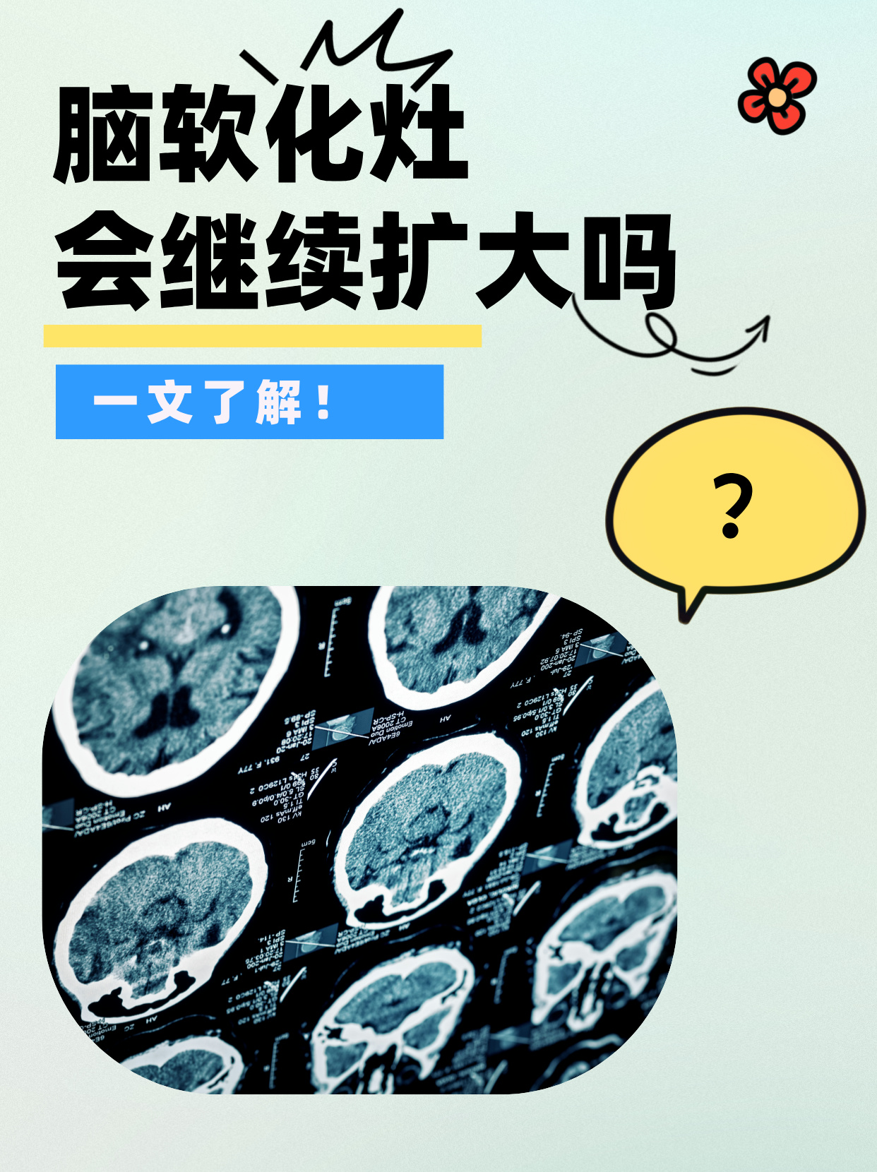 脑软化灶会继续扩大吗?一文了解!