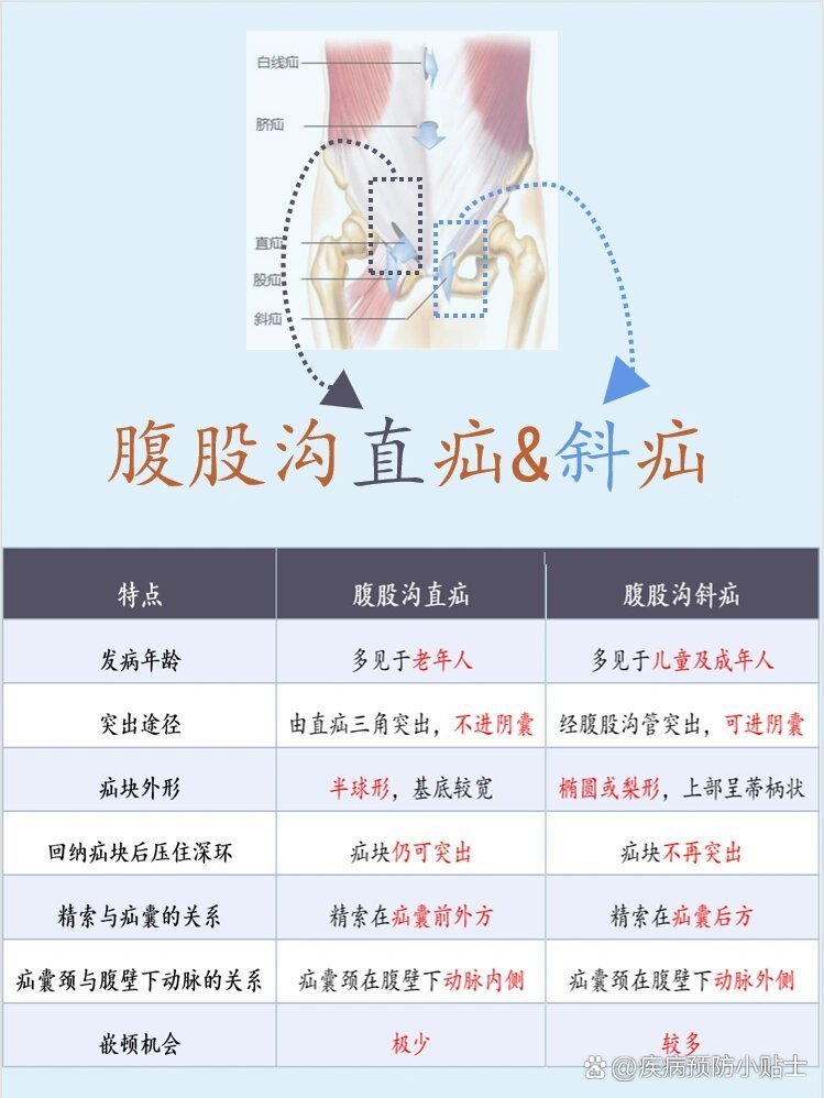 斜疝与直疝的鉴别表格图片