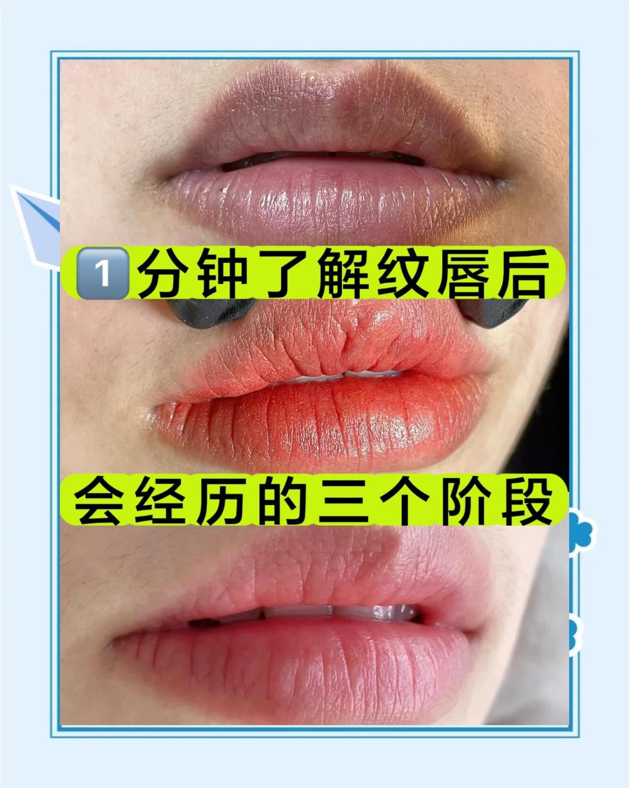 纹唇后必经的三个阶段，你知道吗？