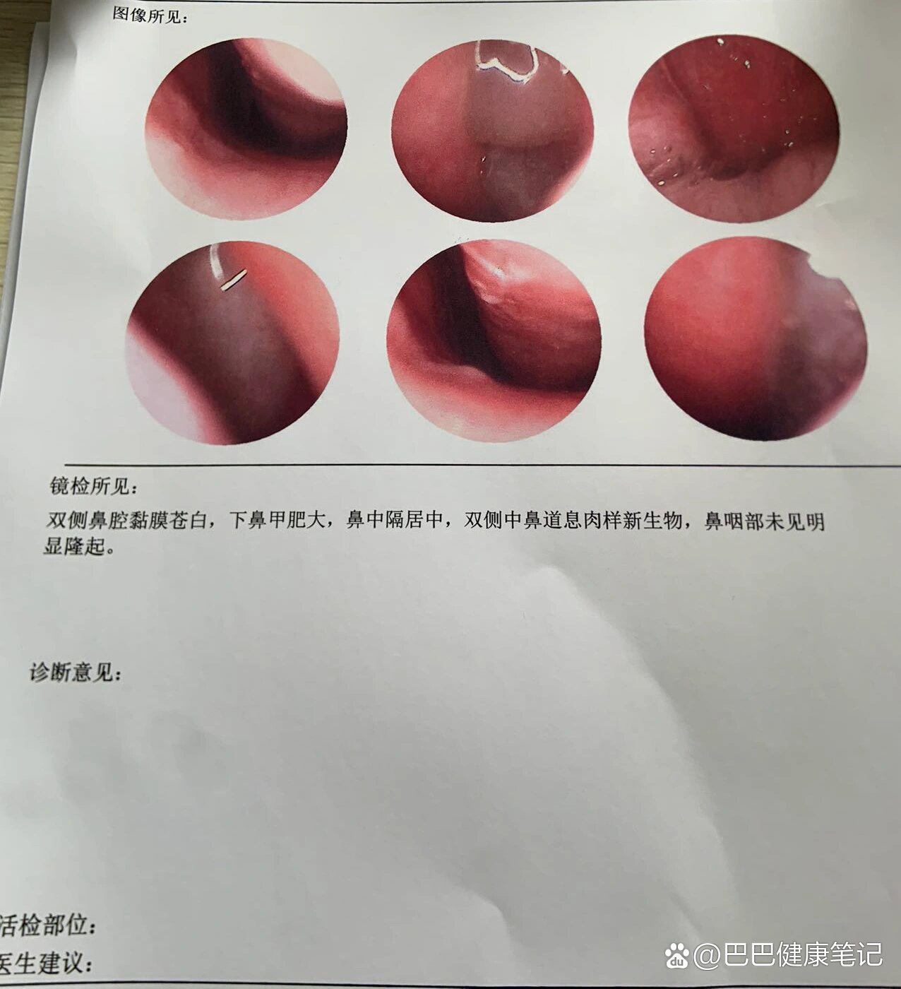 鼻息肉