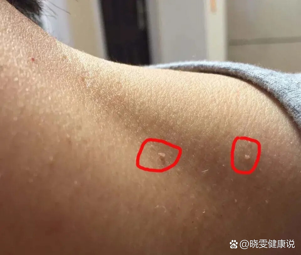 的情况,就是脖子,腋窝下面或者是腹股沟等地方会有一些隆起的肉疙瘩